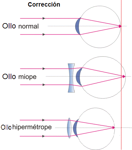 Correción da miopía e hipermetropía