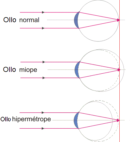 Miopía e hipermetropía