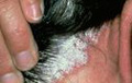 Psoriasis en cuero cabelludo. Cuero cabelludo con psoriasis en nuca.