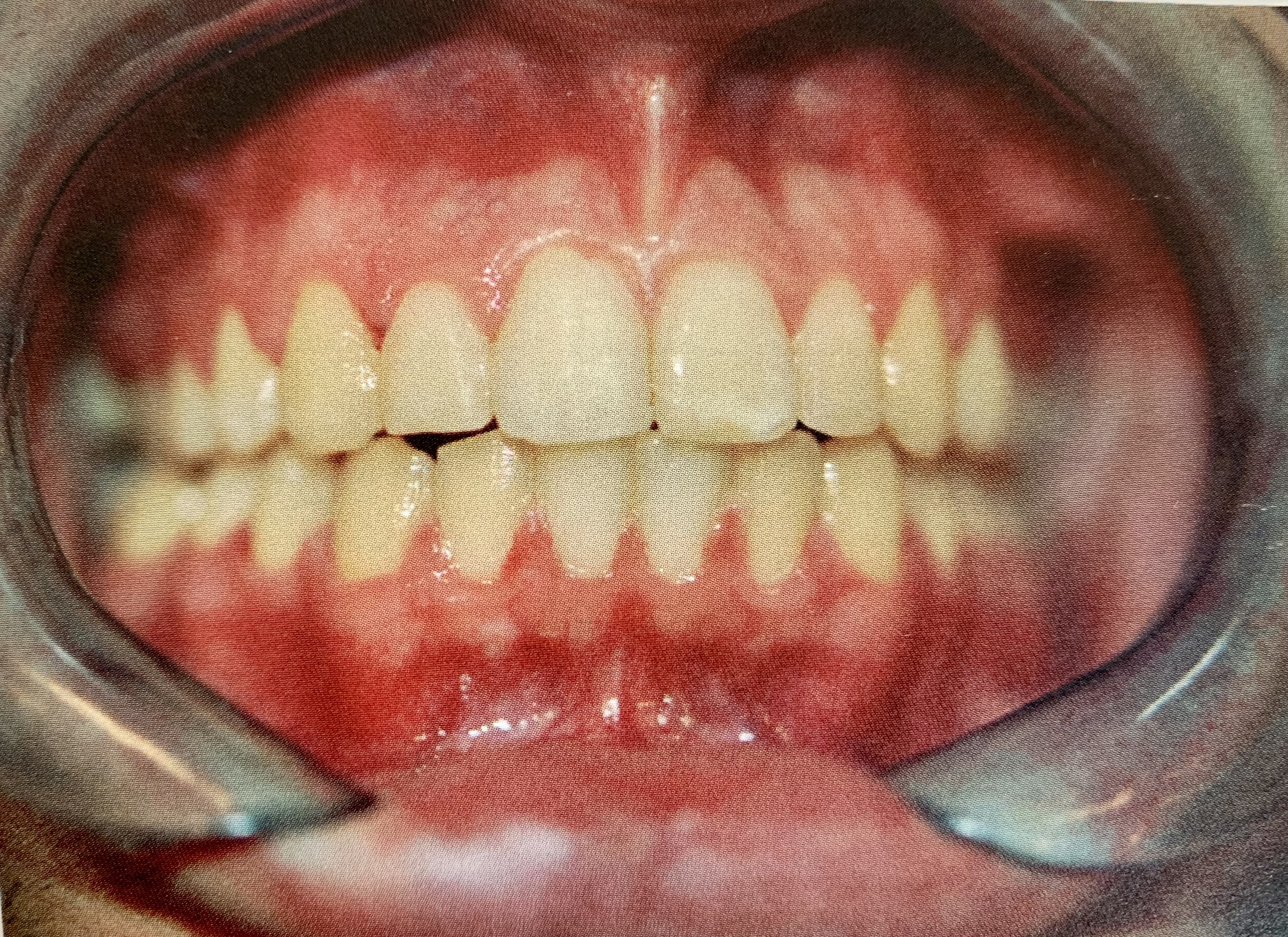 Línea media dentaria