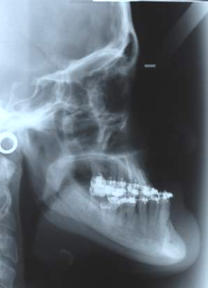 Macrognatismo