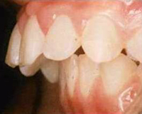 Progantismo maxilar y retrognatismo mandibular