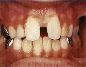 Diastema interincisal