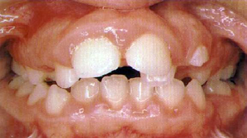 Respirador oral con arcada superior estrecha y protrusión dentoalveolar