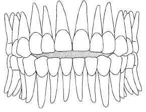 Mordida abierta anterior