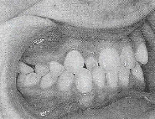 Microdoncia